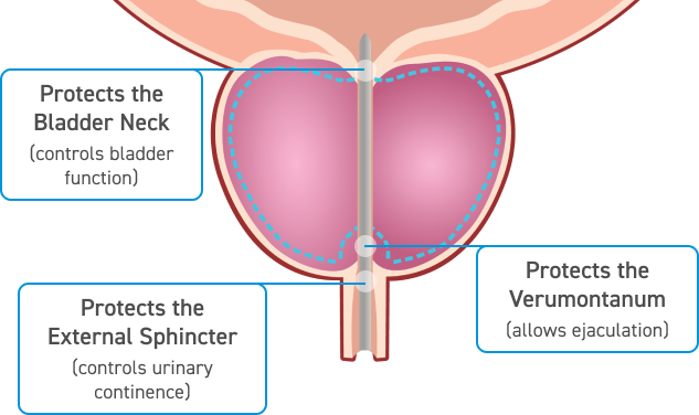 An illustration of the prostate gland, highlighting bladder neck, external sphincter, and verumontanum with their functions.