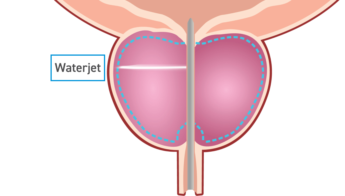A medical illustration showing a cross-section of a prostate with a waterjet treatment being applied to it.